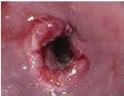 Esophageal cancer