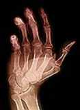 Rumatoid arthritis